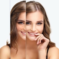 Holistic treatment of acne in Delhi